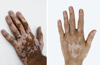 Vitiligo ~ Skin loses its colour