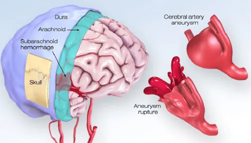Aneurysm 🏥Blood Vessel🩸