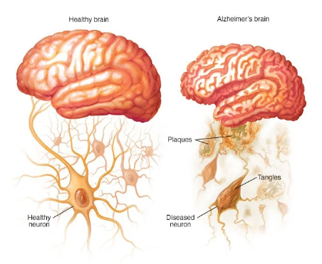 Alzheimer_Dementia_Brain_Atapama
